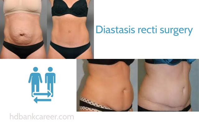 Before and after photos of diastasis recti surgery